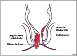 Zeichnung Analfistel