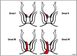 Zeichnung Analabszess